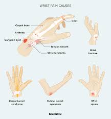 Wrist Pain: Causes, Symptoms ...